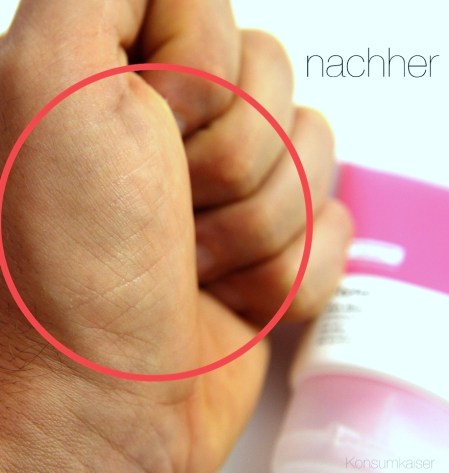 1nachher-kkhylamidehabluranwendung3